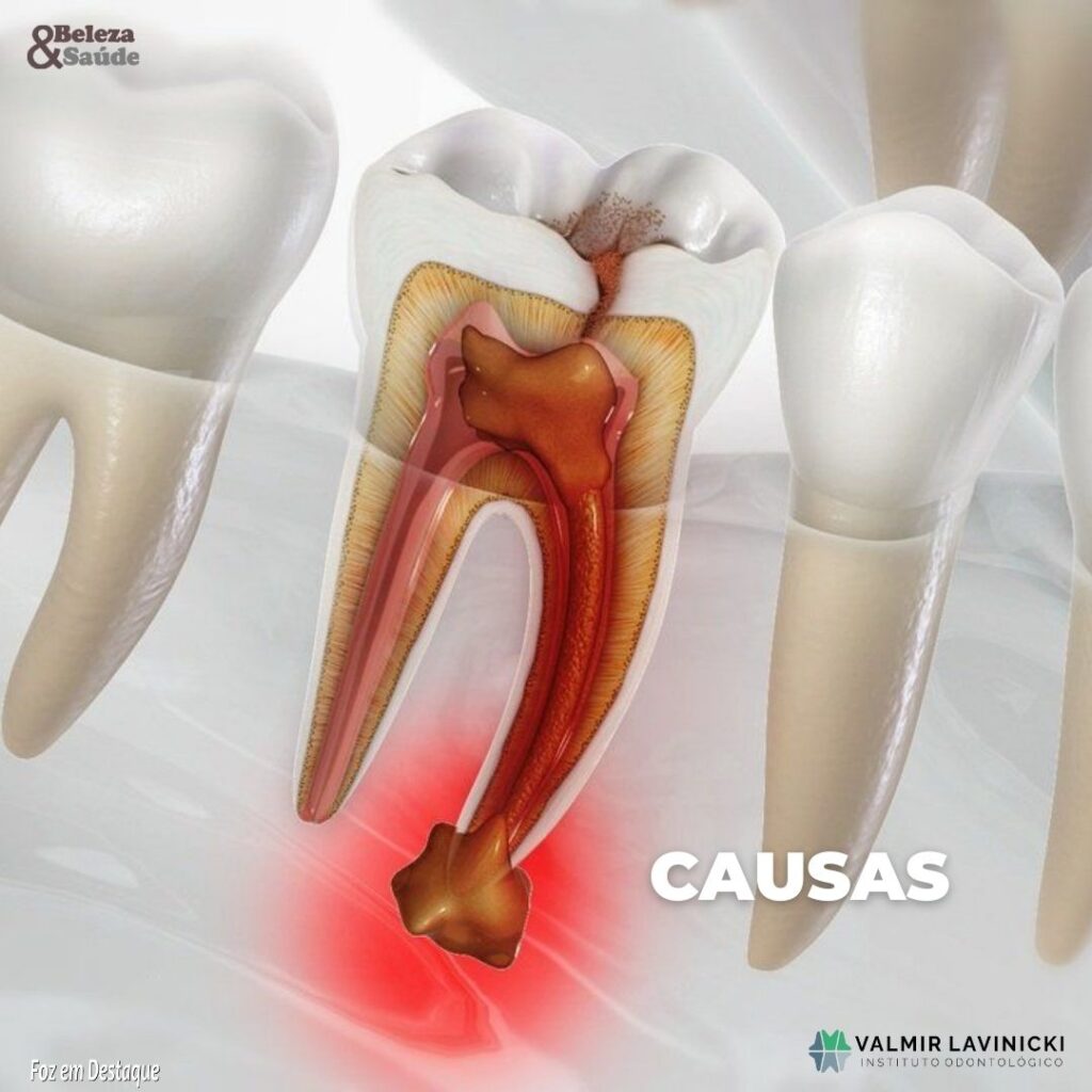 Infecção dental Instituto Odontológico Valmir Lavinicki